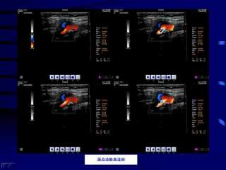 Sistema de diagnóstico ultrasónico de Doppler de color CMS1800 